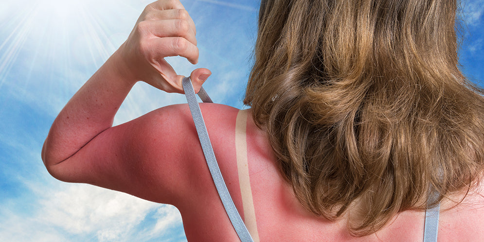 Eritema solare: cause e sintomi, rimedi e prevenzione