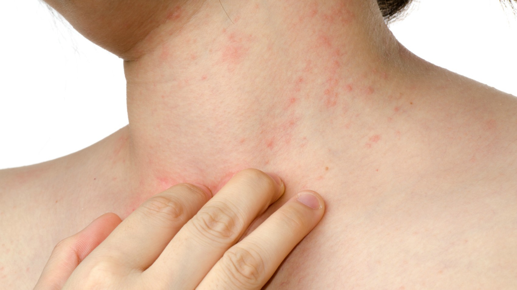 Dermatite Da Pannolino Sintomi E Cure Naturali Sexiz Pix