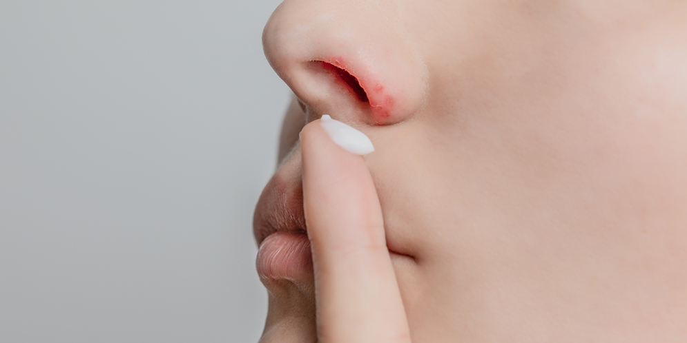 Herpes nasale: cause, sintomi, cure e rimedi in farmacia