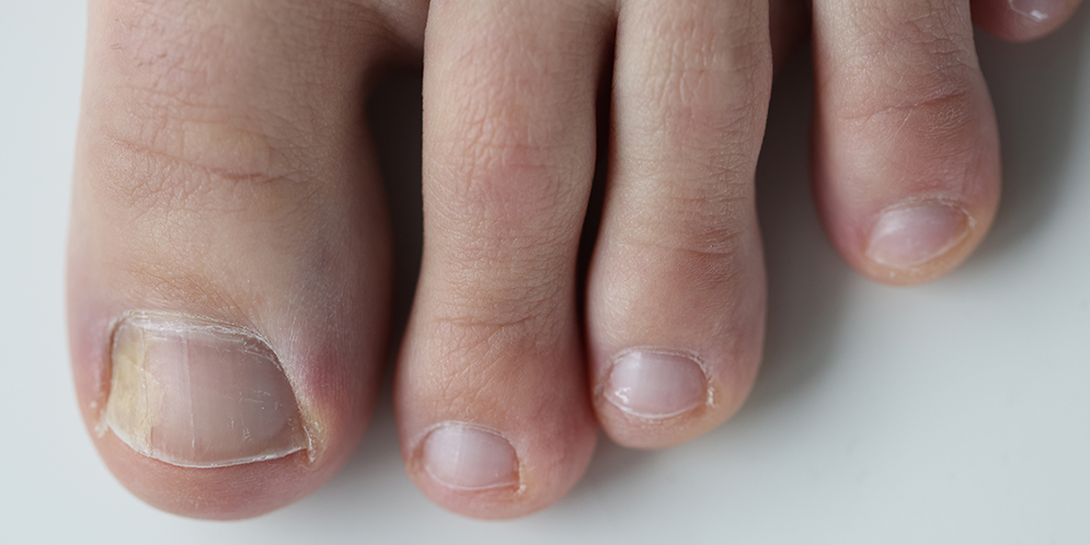 Unghie dei piedi gialle: cosa fare e rimedi in farmacia